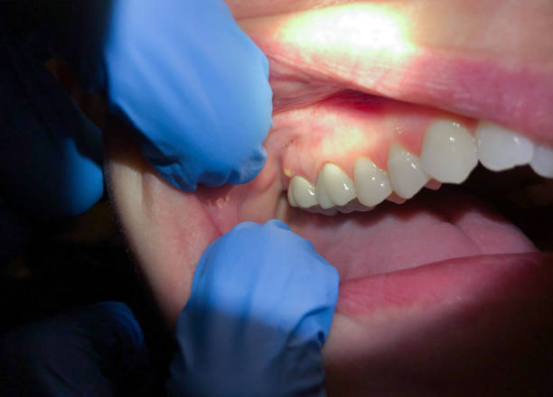 Best Knocked-Out Tooth Emergency  in Creedmoor, NC
